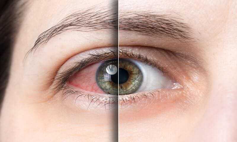 dry-eye-and-normal-eye.jpg